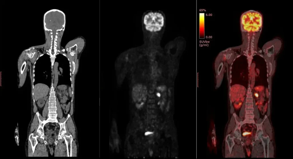 PET Scan vs CT Scan