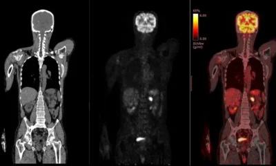 PET Scan vs CT Scan