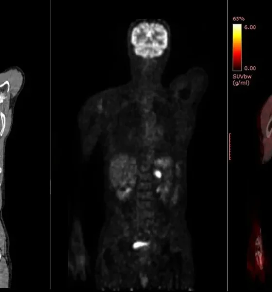 PET Scan vs CT Scan